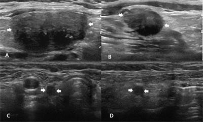 Postoperative Neck Ultrasonography Surveillance After Thyroidectomy in Patients With Medullary Thyroid Carcinoma: A Multicenter Study